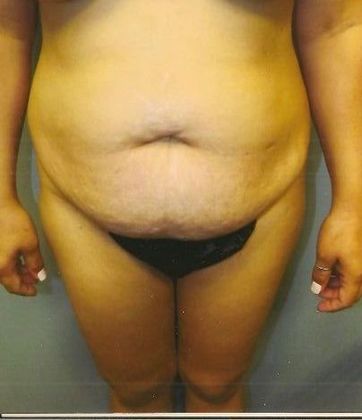 Tummy Tuck: Case 12 - Before