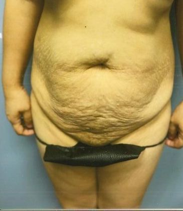 Tummy Tuck: Case 13 - Before