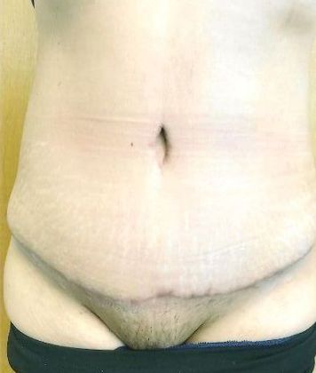 Tummy Tuck: Case 13 - After