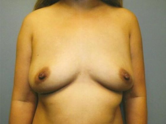 Breast Augmentation: Case 25 - Before
