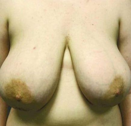 BREAST REDUCTION Case 1 - Before