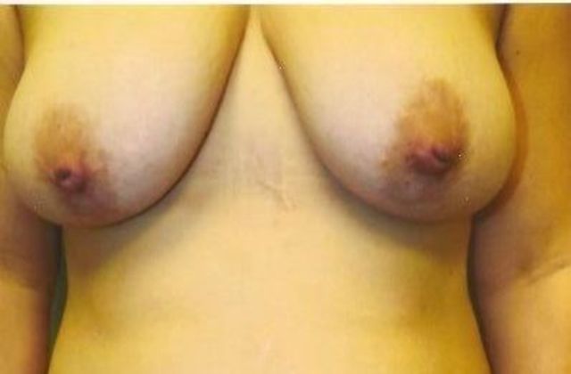 Breast Lift Case 2 - Before