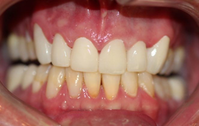 Smile Makeovers, actual cases of our dentists, no special lighting or editing Cases