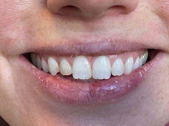 Porcelain Veneers: Case 10 - Before