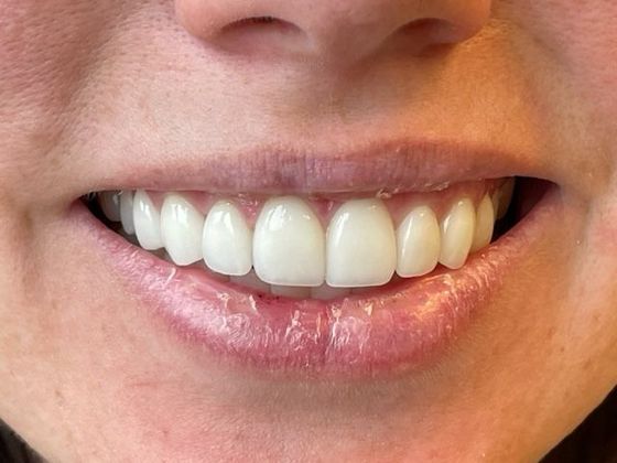 Porcelain Veneers: Case 10 - After