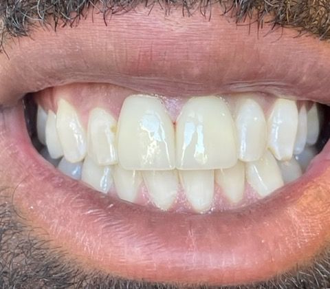 Smile Makeovers Case 3 - After