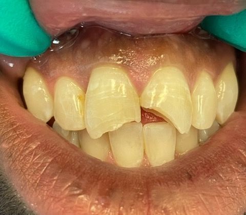 Porcelain Dental Crowns Case 1 - Before