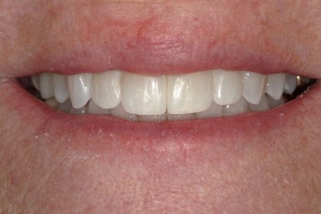 Bonding Case 10 - After