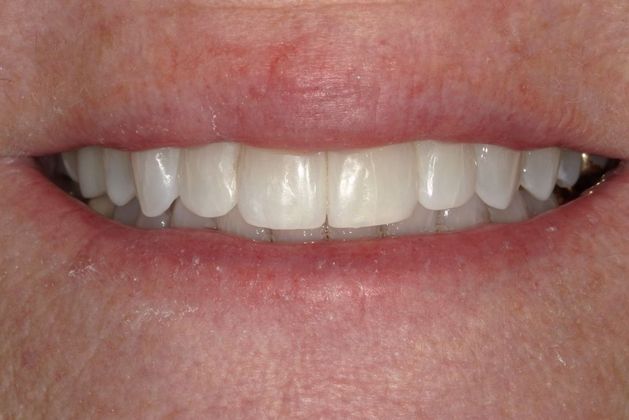 Invisalign Case 20 - After