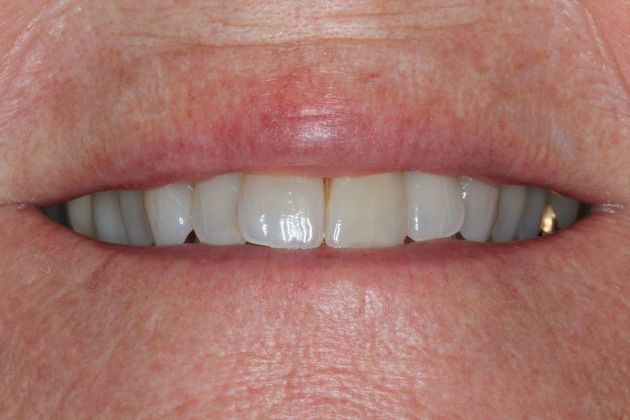 Invisalign Case 20 - Before