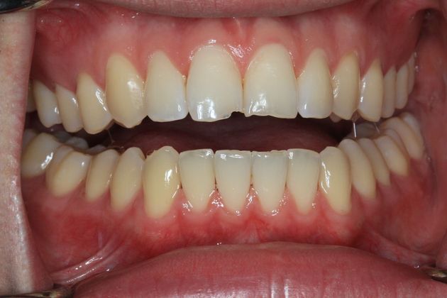 Bonding Case 11 - Before