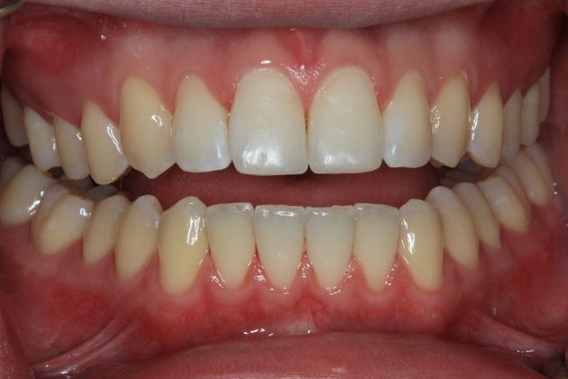 Bonding Case 11 - After