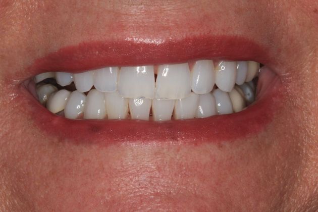 Bonding: Case 12 - Before