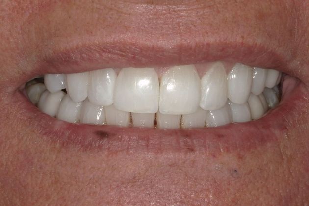 Bonding: Case 12 - After