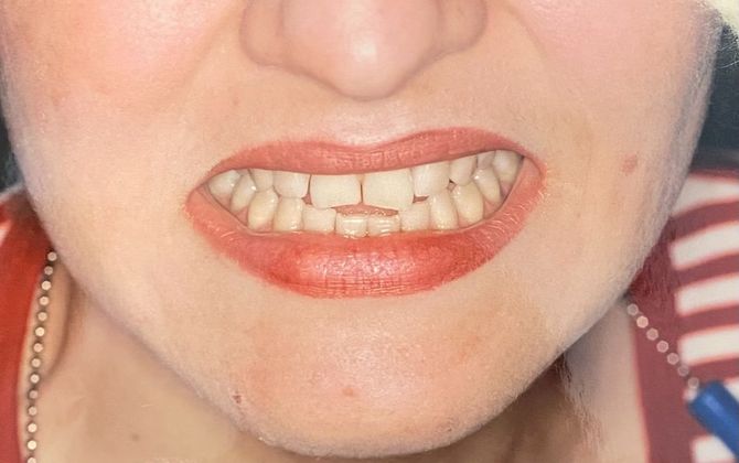 Before and After Gallery Case 10 Bonding - Before