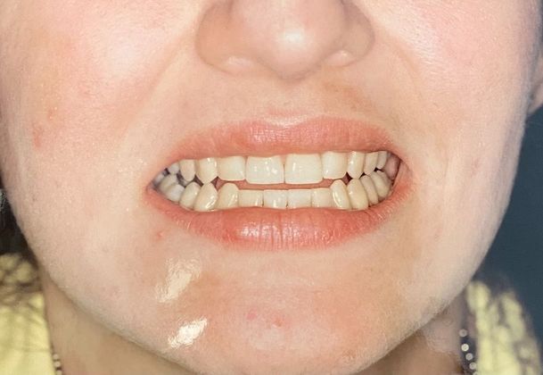 Before and After Gallery Case 10 Bonding - After