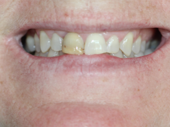 Smile Makeovers, actual cases of our dentists, no special lighting or editing Case 21 - Before