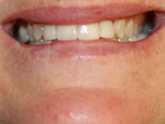 Smile Makeovers, actual cases of our dentists, no special lighting or editing Case 21 - After