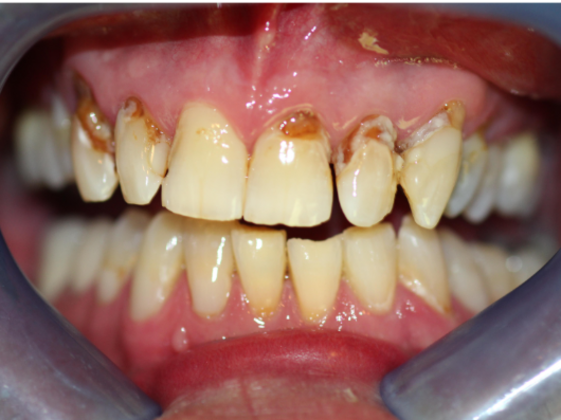 Smile Makeovers, actual cases of our dentists, no special lighting or editing Case 23 - Before