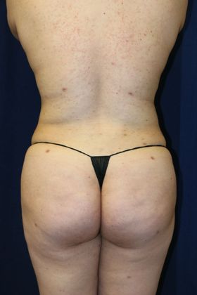 Brazilian Butt Lift : Case 11 - After