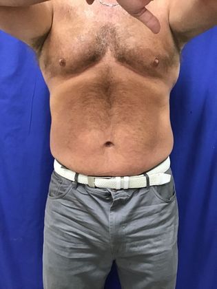 Body Coolsculpting: Case 11 (RxP1316) - After