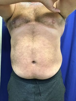 Body Coolsculpting: Case 11 (RxP1316) - Before