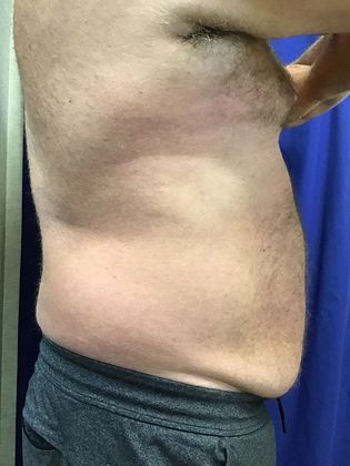 Body Coolsculpting Case 11 (RxP1316) - Before