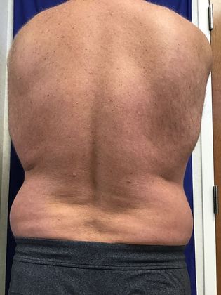 Body Coolsculpting: Case 11 (RxP1316) - Before