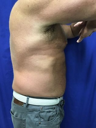 Body Coolsculpting Case 11 (RxP1316) - After