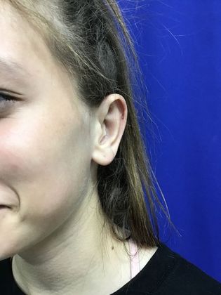 Ear Correction / Otoplasty: Case 4 (Client ID: 2070466) - After