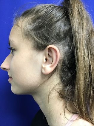 Ear Correction / Otoplasty: Case 4 (Client ID: 2070466) - After