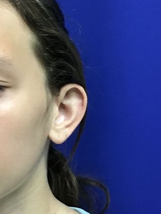Ear Correction / Otoplasty: Case 4 (Client ID: 2070466) - Before