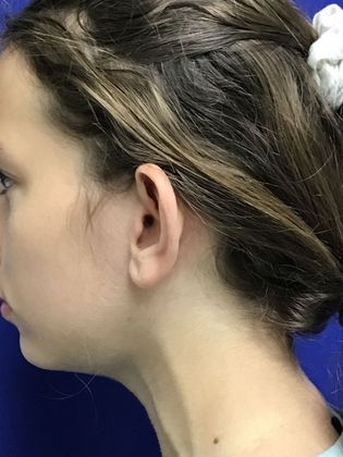 Ear Correction / Otoplasty: Case 4 (Client ID: 2070466) - Before