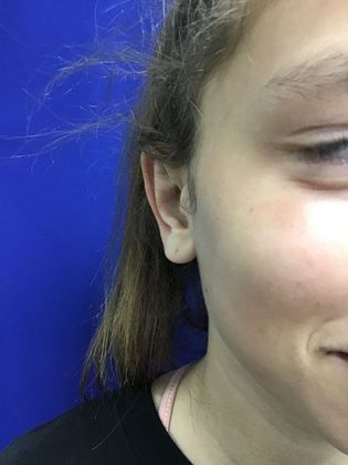 Ear Correction / Otoplasty: Case 4 (Client ID: 2070466) - After