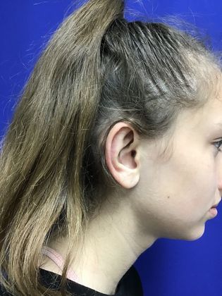 Ear Correction / Otoplasty: Case 4 (Client ID: 2070466) - After
