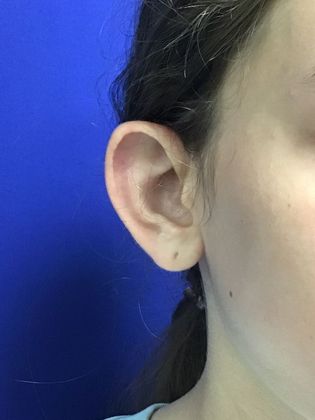Ear Correction / Otoplasty: Case 4 (Client ID: 2070466) - Before