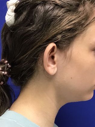Ear Correction / Otoplasty: Case 4 (Client ID: 2070466) - Before