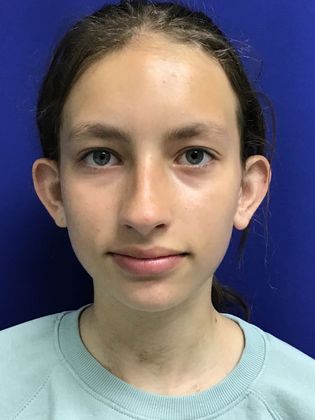 Ear Correction / Otoplasty Case 4 (Client ID: 2070466) - Before