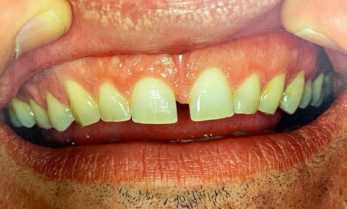 Before and After Gallery Case 11 Bonding - Before