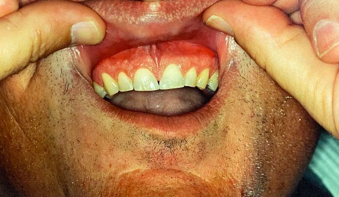 Before and After Gallery Case 11 Bonding - After