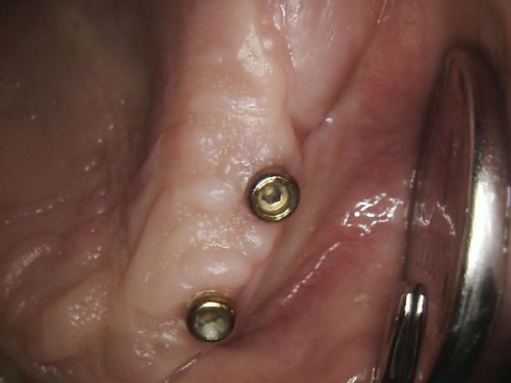 Dental Implants Case 10 - Before