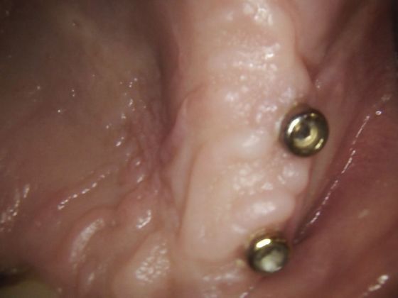 Dental Implants: Case 10 - Locator Abutments