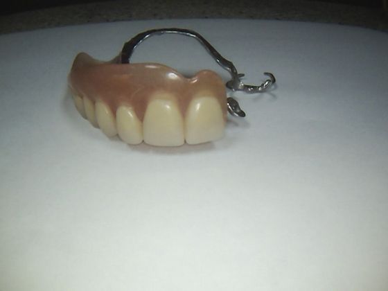 Dental Implants Case 10 - After