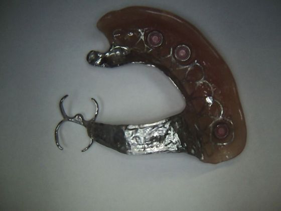 Dental Implants: Case 10 - Upper Partial Denture