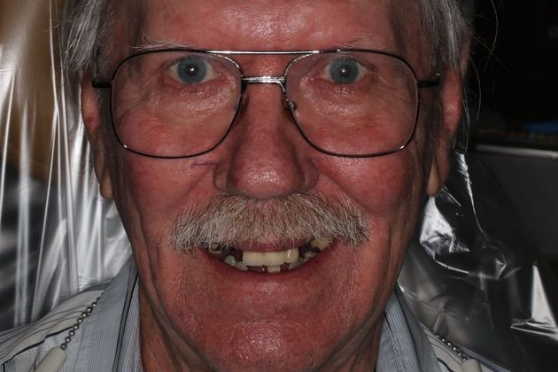 Dentures Case 10 - Before