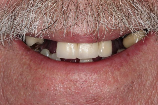 Dentures: Case 10 - Before