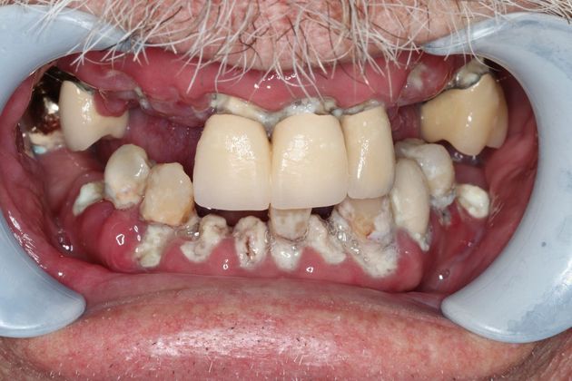 Dentures: Case 10 - Before