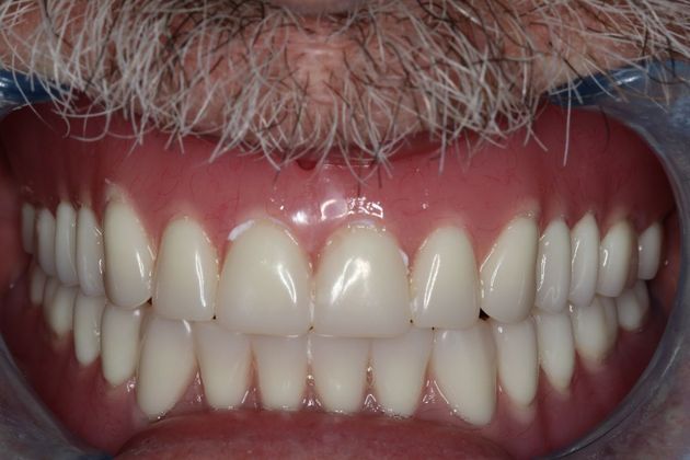 Dentures: Case 10 - After