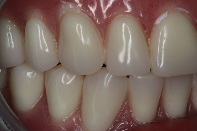 Dentures: Case 10 - After