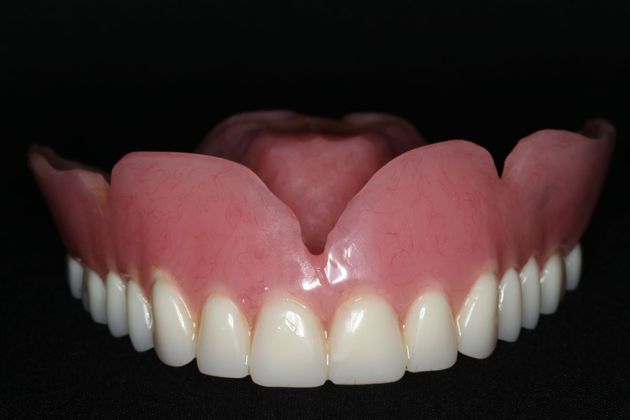 Dentures: Case 10 - Upper Denture